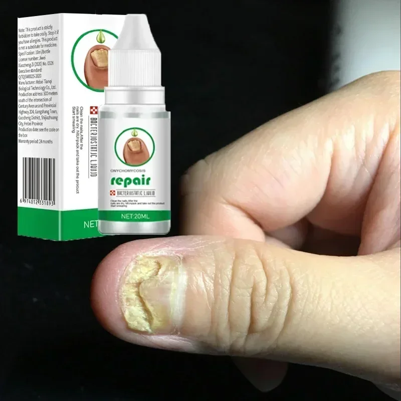 Nail Repair Essence Fungal Nail Treatment Removal Onychomycosis Toe Nail Nourishing Hand and Foot Care