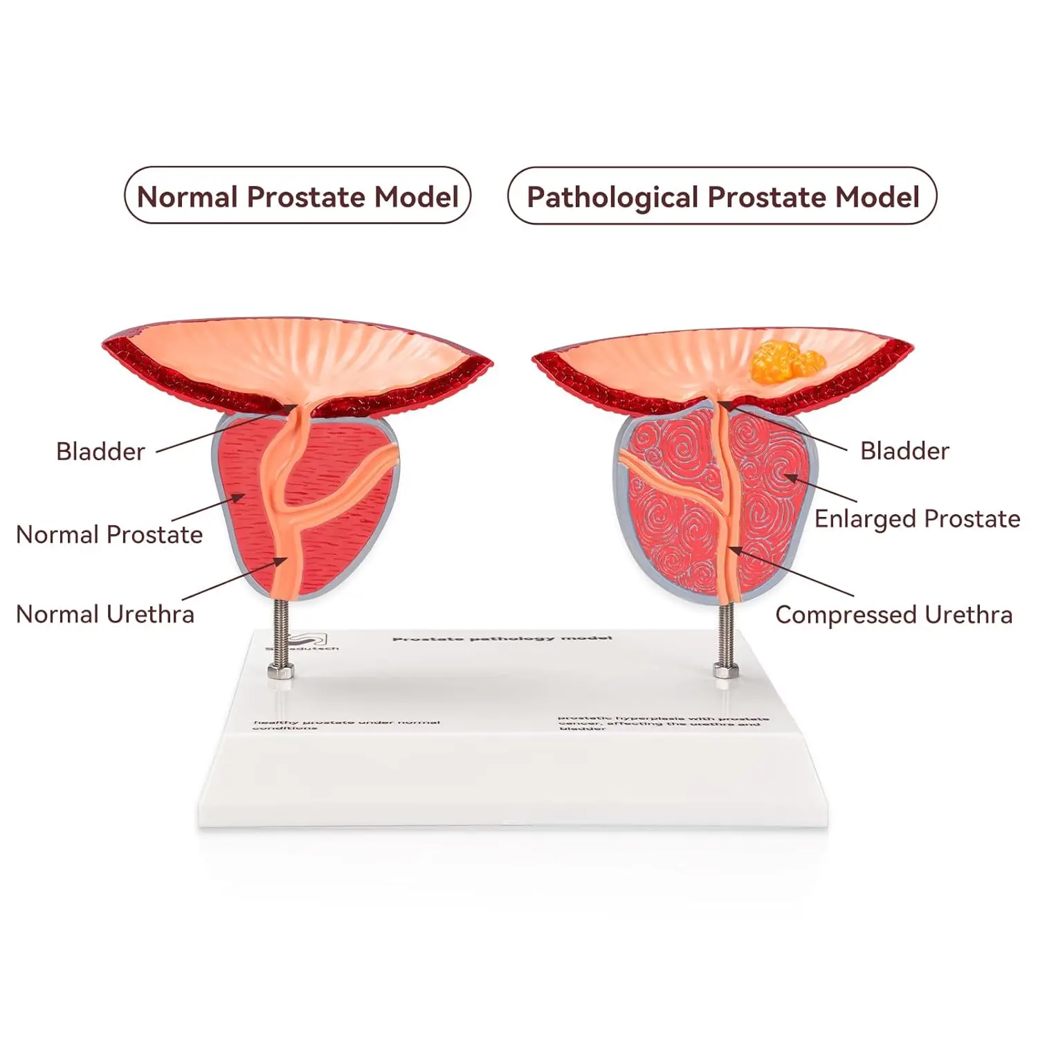 Ultrassist Prostate Pathological Anatomy Model Male Urinary Reproductive Detachable 3D Prostate BPH & Cancer for Medical Student