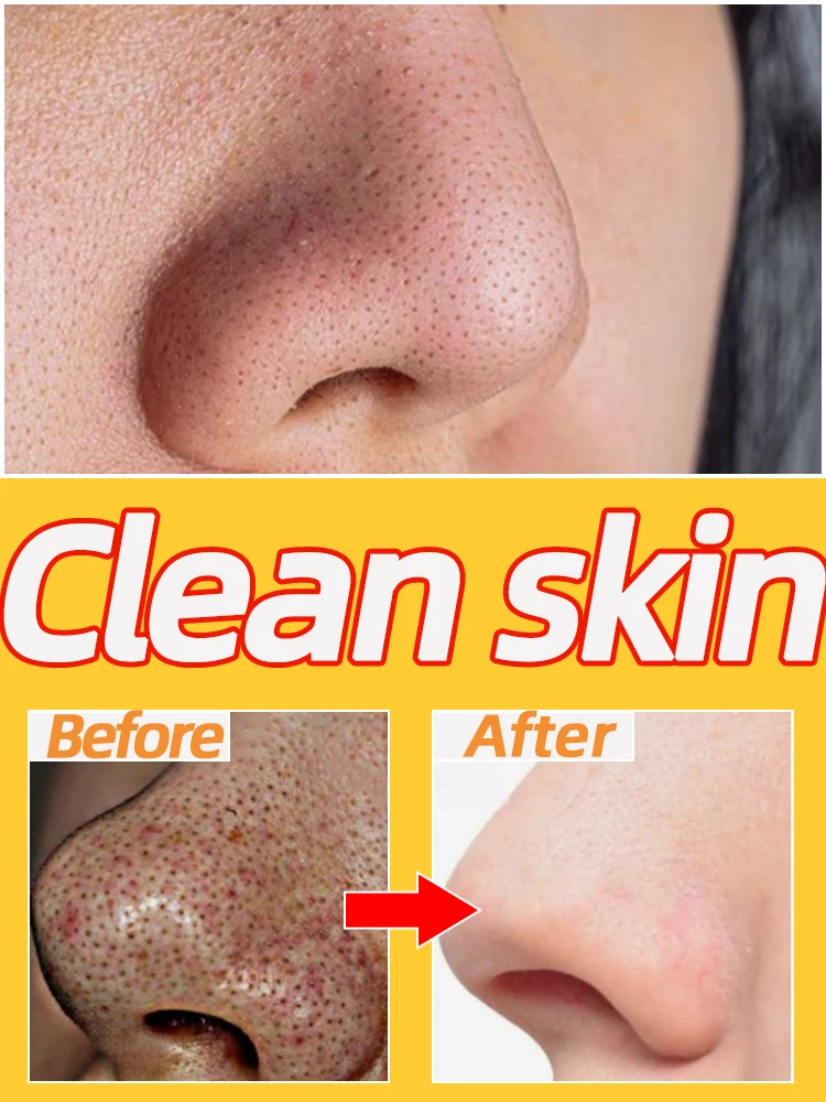 

Blackhead Skin Care