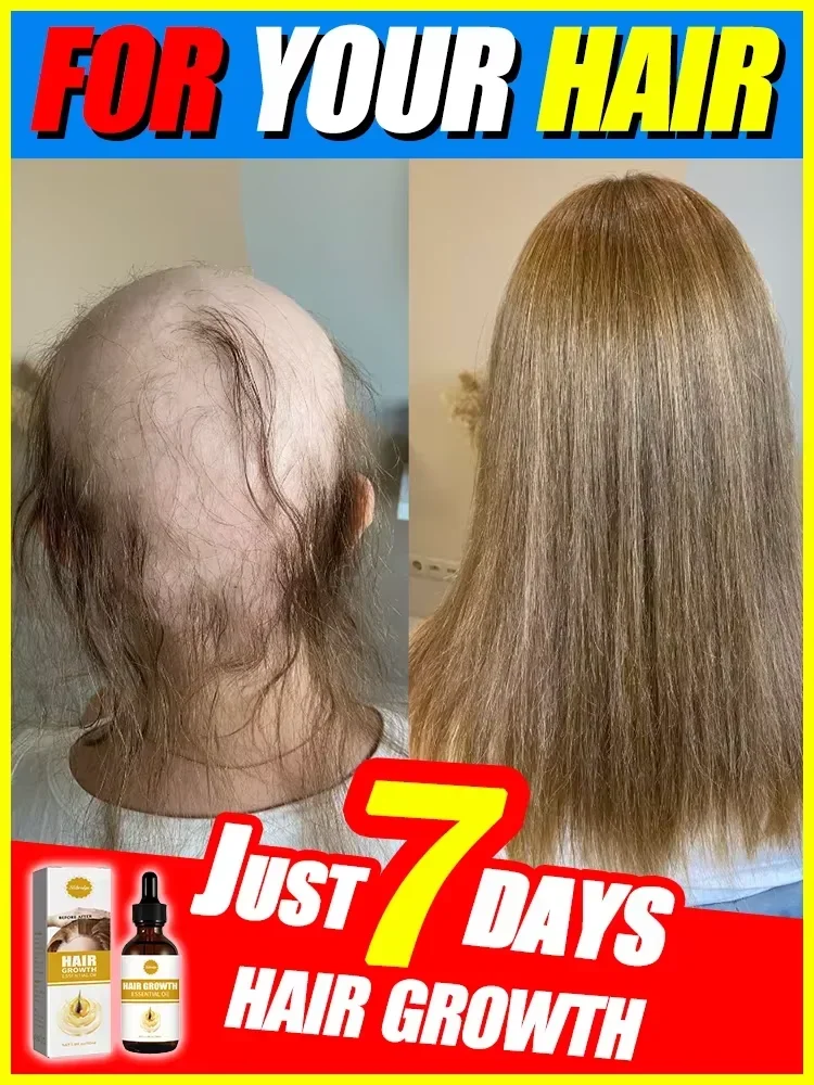 

O óleo de crescimento capilar faz o cabelo crescer rapidamente, repara eficazmente a calvície e a queda de cabelo hereditária