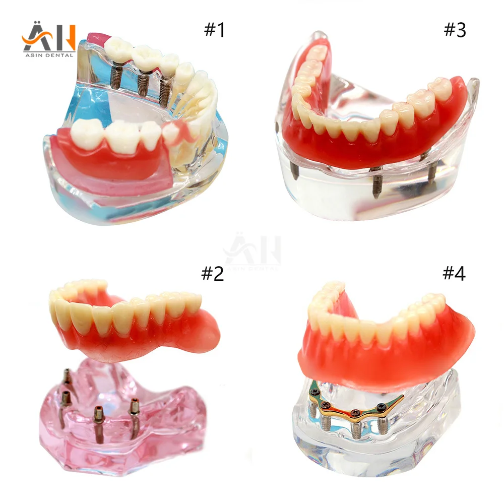 

Multiple Types Dental Teeth Model With Implants Overdenture Superior Demo Model For Student Dentist Patient Communication Model