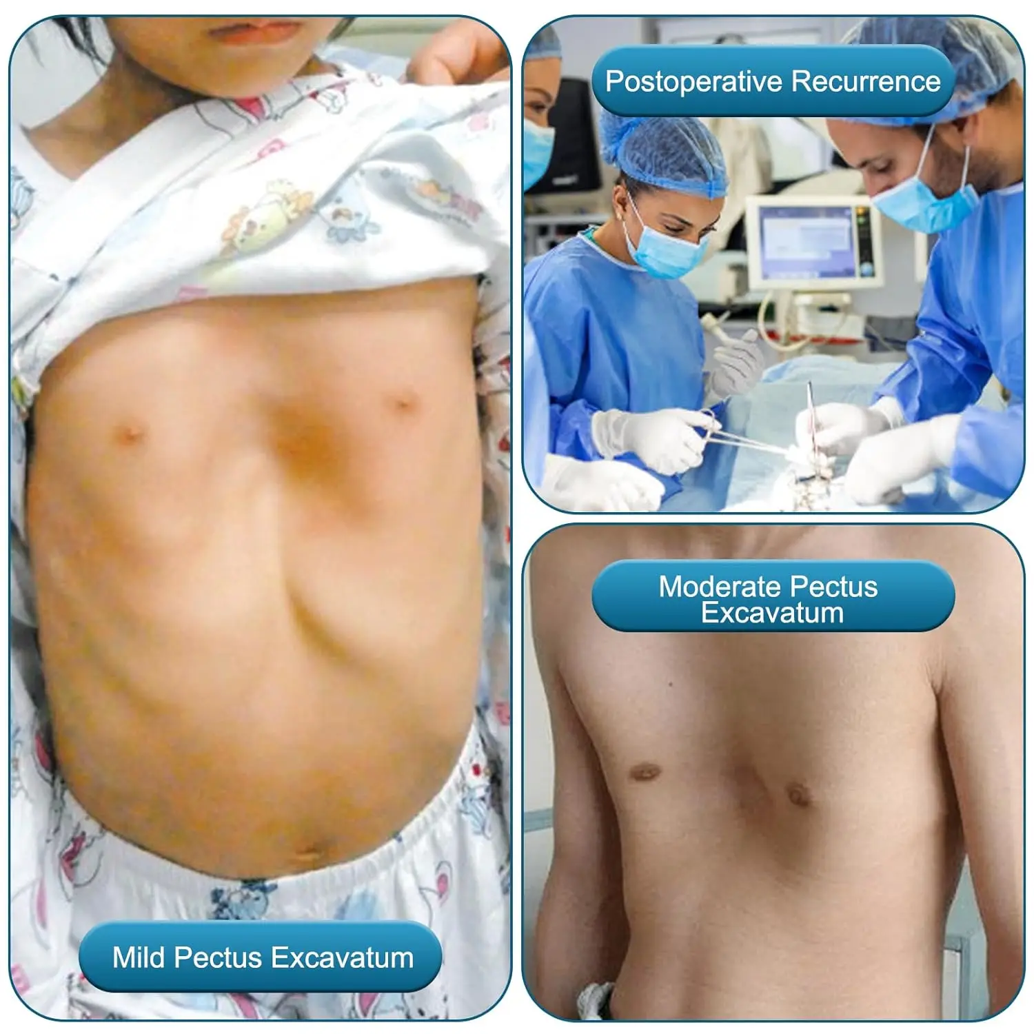 جرس فراغ حفارة Pectus - دعامة جبيرة حفارة Pectus، تصحيح جسدي، قابل للغسل، مع مقياس الضغط
