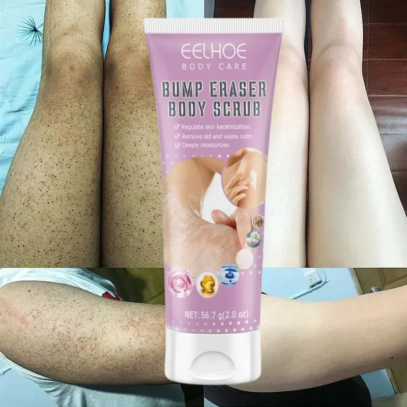 Crema exfoliante corporal rápida de 7 días, reparación de la piel hidratante, queratosis Pilaris, eliminación de fresas, borrador de piernas,