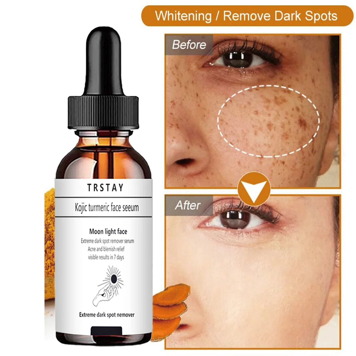 

TRSTAY Эссенция для удаления темных пятен, облегчение пятен от прыщей, уход за кожей, крем для тела для мам и детей, видимые результаты за 7 дней