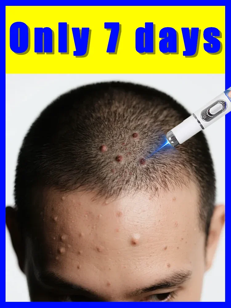 

Blue light wart removal pen, solve your troubles in 7 days,hot sale wart care tools