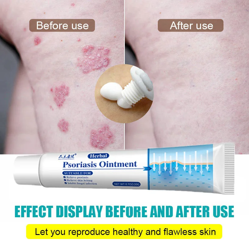 Original Psoriasis Cream Eczema Treatment Cream Psoriasis Hand Foot Odor Versicolor Inhibit Dermatitis Fungus Anti-itch Ointment