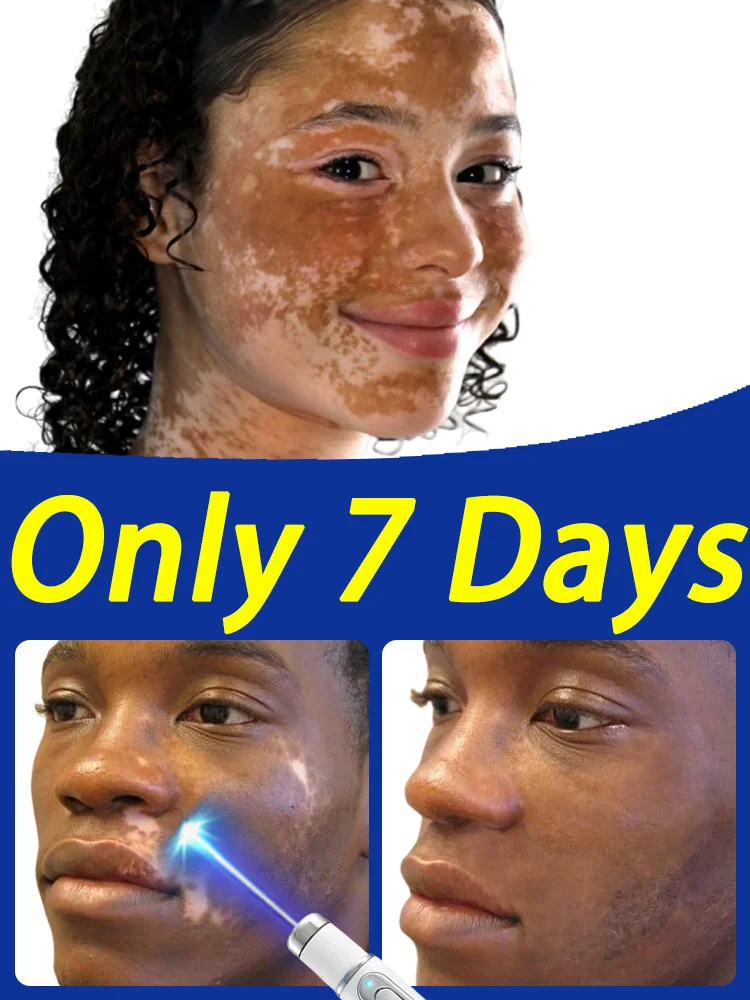 

Vitiligo Melanin Growth for white spots