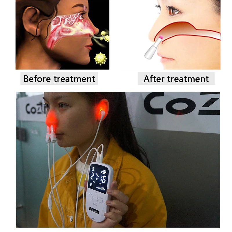 

Allergy Relief Rhinitis Therapy Sinusitis Machine Sneezing Nasal itching Nose Care Device Safety Laser Light Treatment Device