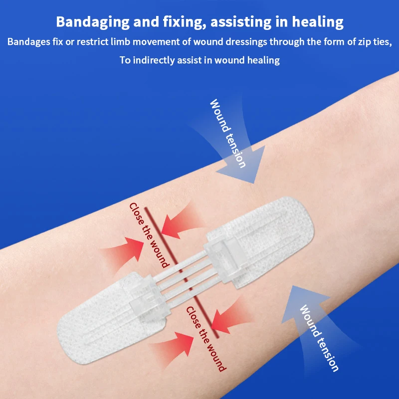 Zíper gravata fechamento de ferida remendo hemostático ferida sutura rápida zíper band-aid ao ar livre ataduras portáteis para cuidados com feridas