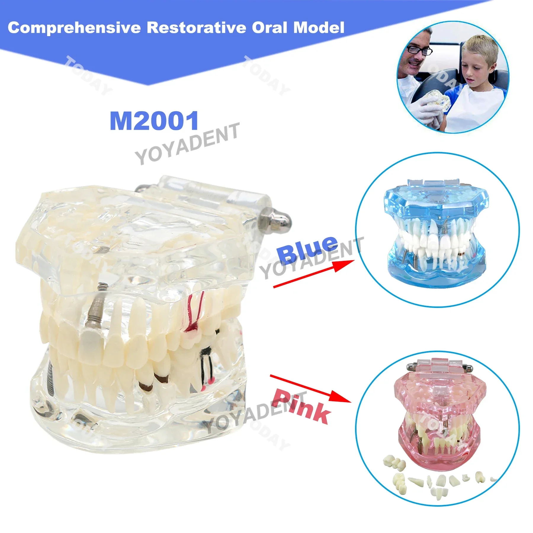 

Dental Model Implant Teeth Model With Restoration Bridge Teaching Model Dentistry Dentist Demo Studying Resins Model