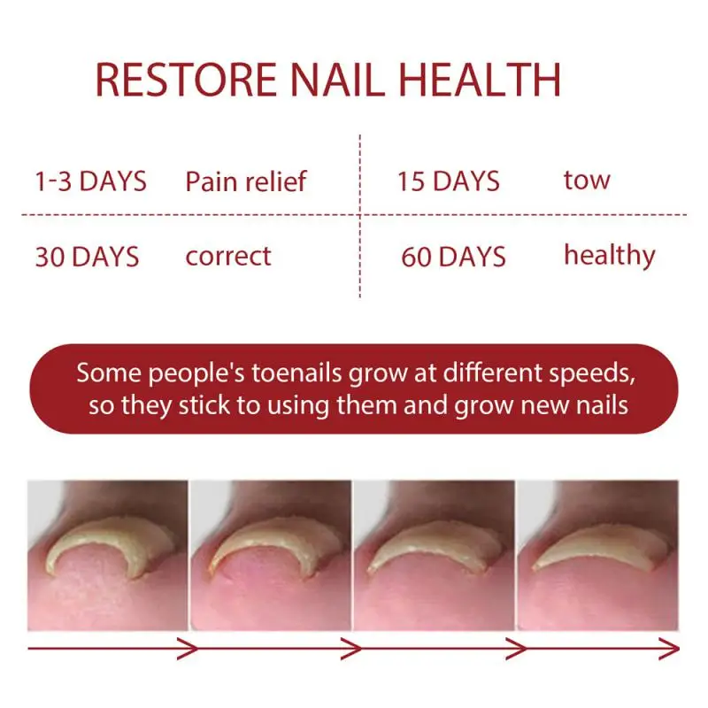 جهاز ليزر الأظافر الفطري ، كابل بيانات ، Onychomycosis ، يزيل الفطريات ، علاج ، هدية العناية بالأظافر ، 10 ، 5 ، 3 ، 1 ،