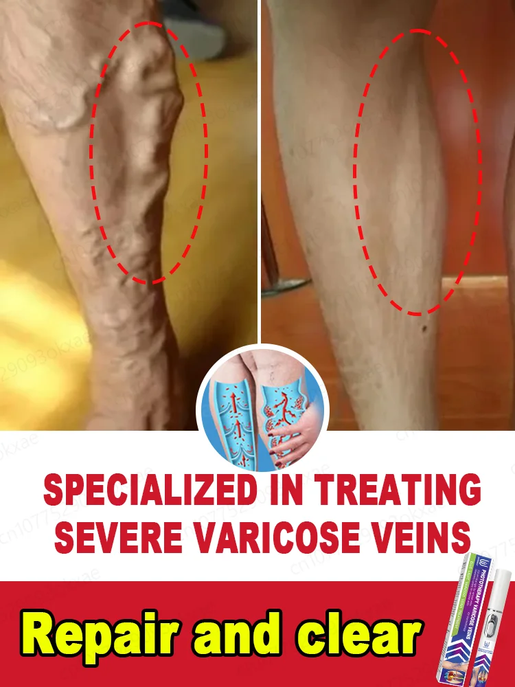 

Improve blood circulation and reduce varicose veins Laser pointer for varicose veins