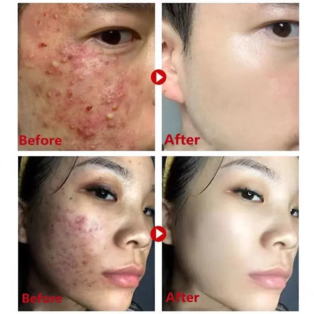 Blackhead Remover Face Mask ครีม Deep Cleansing Mask Facial ปัดเป่าสิว Blemish รูขุมขนหดตัวความงามเกาหลีเครื่องสําอาง Skin Care