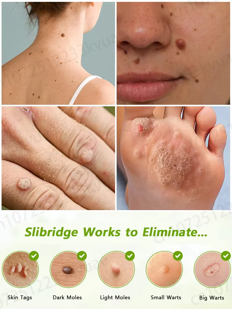 These inconspicuous little bumps not only affect ᵒⁿᵉ'ˢ ᵃᵖᵖᵉᵃʳᵃⁿᶜᵉ ᵇᵘᵗ ᵃˡˢᵒ ᶜᵃᵘˢᵉ ᵖᵃⁱⁿ