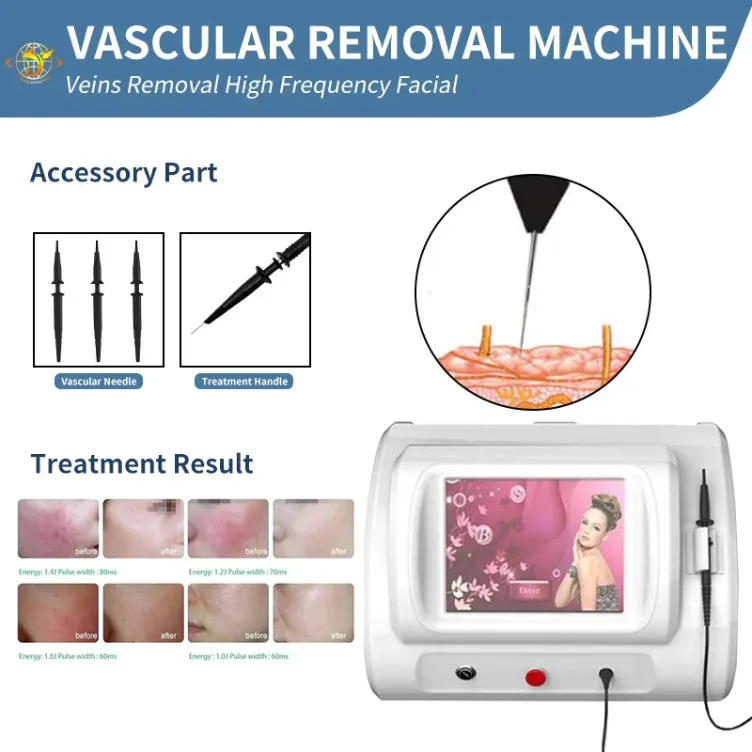 Beauty 30Mhz High Frequency Rbs Vascular Blemishes Telangiectasia Blood Moles Removal Machine Beauty Equipment