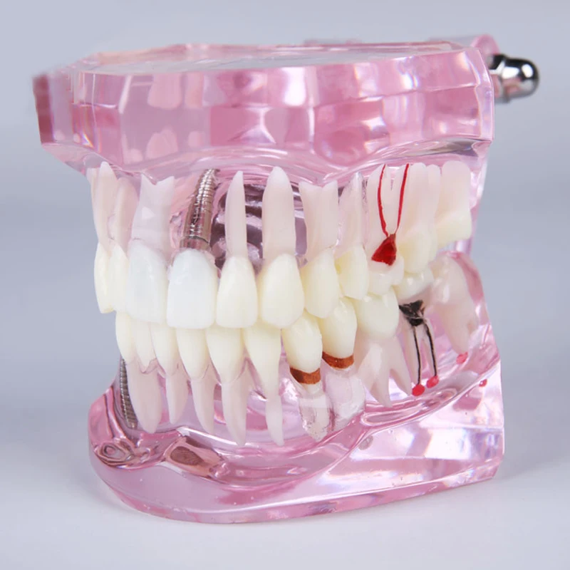 Dental M2001 Implant and Restoratin Model Fixing Bridge Post and Core Crown Teeth Model