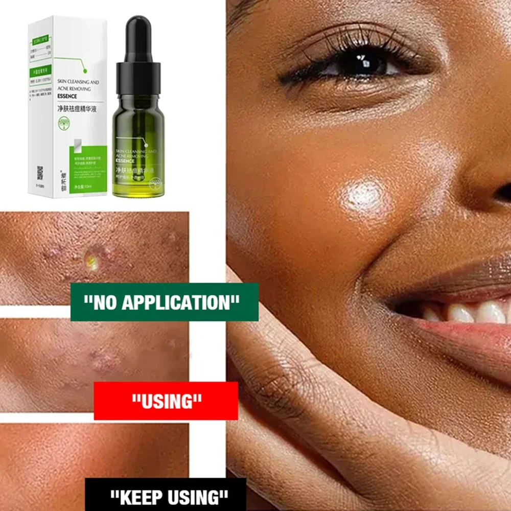 

Natural Acne Remover Face Serum, Pimple Remover, Pore Minimizer, Oil Control Skin Care Solution