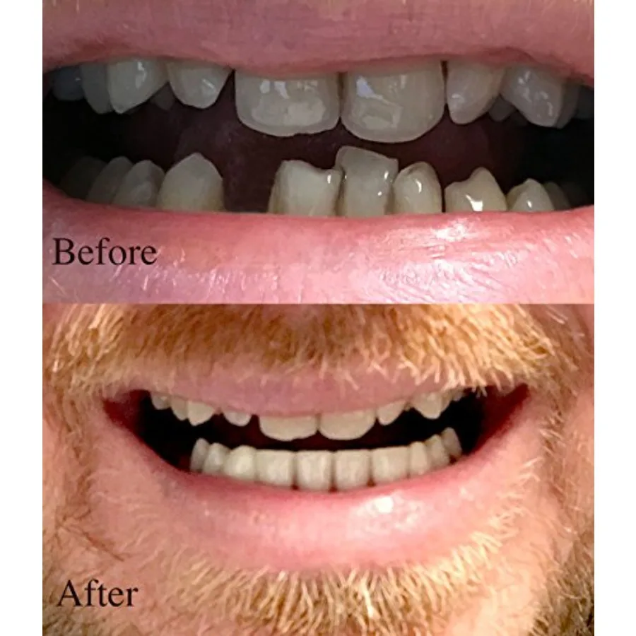 Instant Smile Professional Cosmetic Lower Teeth - New from Hand crafted detail, custom fit at home!