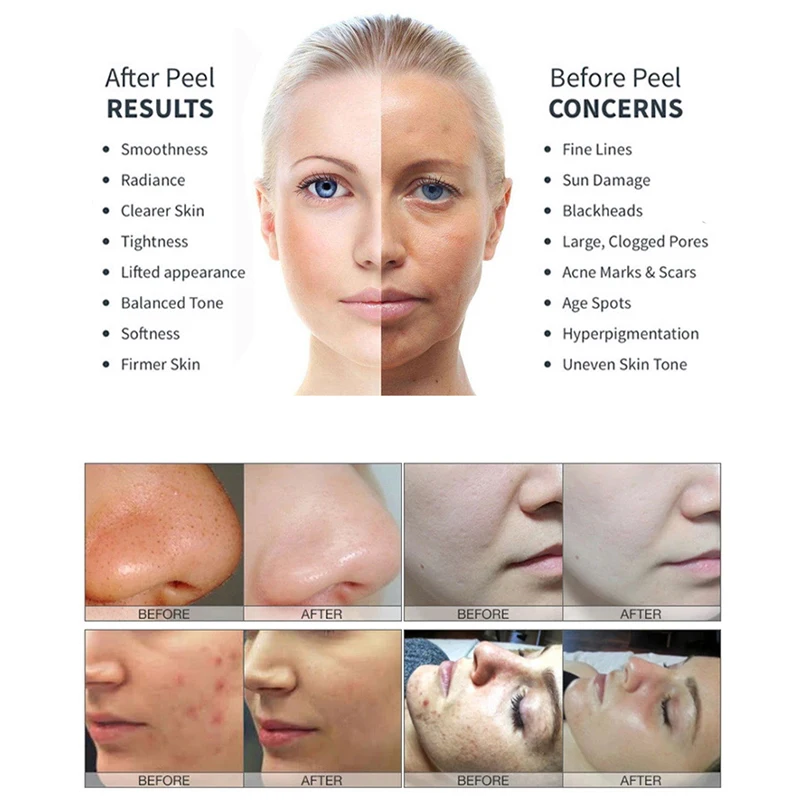 

Многофункциональный аппарат 4-в-1 для гидроэксфолиации и микродермабразии с сильным всасыванием / Вакуумный очиститель от черных точек для салонов красоты