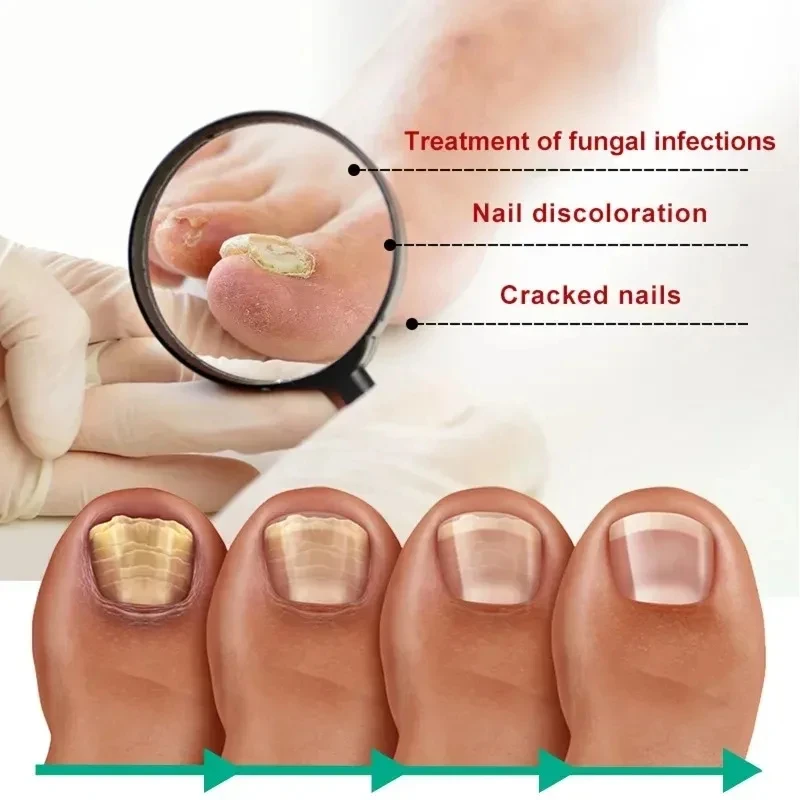 Nagelverzorging Gezichtssence Hand-En Voetverzorging Teennagel Verdikking En Vergeling Verzorging Essentie Ingegroeide Nagel Grijze Nagel Reparatie