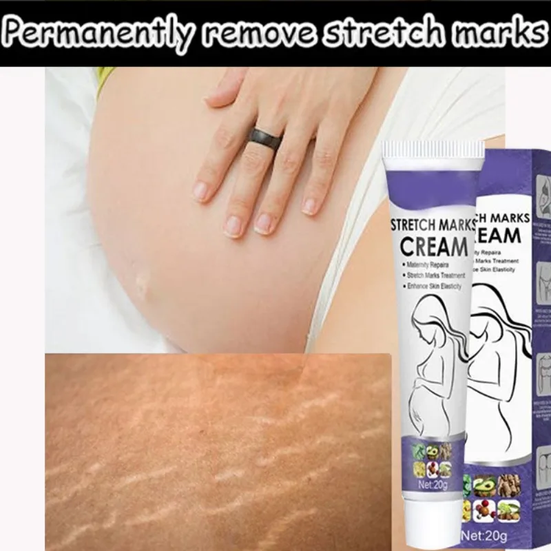 Skin Care Improves Elasticity Effective After Pregnancy Stretch Marks Removal Powerful Maternity Cream Nourishes Skin