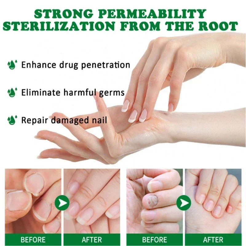 7 Dagen Nagel Schimmel Behandelingen Vloeibare Serum Anti-Infectie Onychomycosis Paronychia Handverzorging Nagels Voet Schimmelverwijdering Gel 30Ml