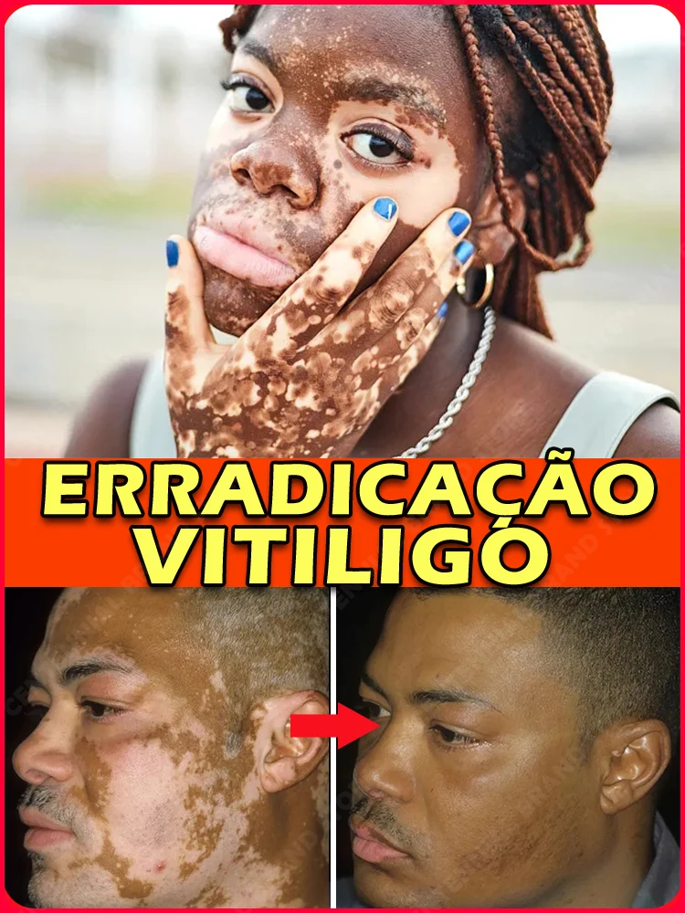 

Pommade anti-vitiligo, crème anti-taches blanches