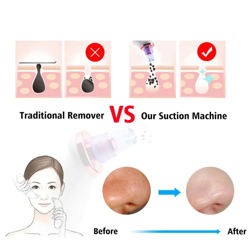ไฟฟ้า สิวหัวดํา Remover สิวหัวดํา Blemish ลบสูญญากาศ Pore CLEANER Exfoliating ทําความสะอาดเครื่องมือความงามบนใบหน้า