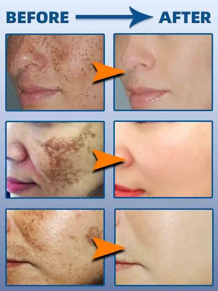 Sommersprossen Melasma Chloasma dunklen Fleck