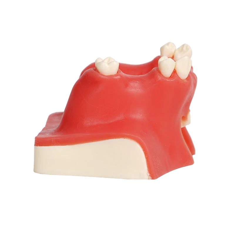 Dental Implant Model Upper Jaw Maxillary Sinus Lift Teaching Practice Model Oral Simulation Implant Soft Gingival Dentistry