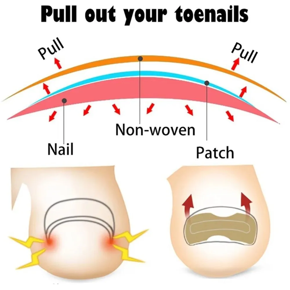 100Pcs Adhesive Ingrown Toenail Correction Stickers Flexible Elastic Nonwoven Toenail Shaping Strips Breathable