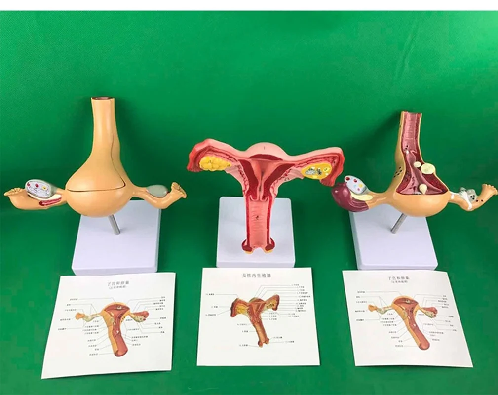 Human Ovary and uterus disease Dissection model Pathology Female uterus model teaching medical aids anatomy lesion uterus