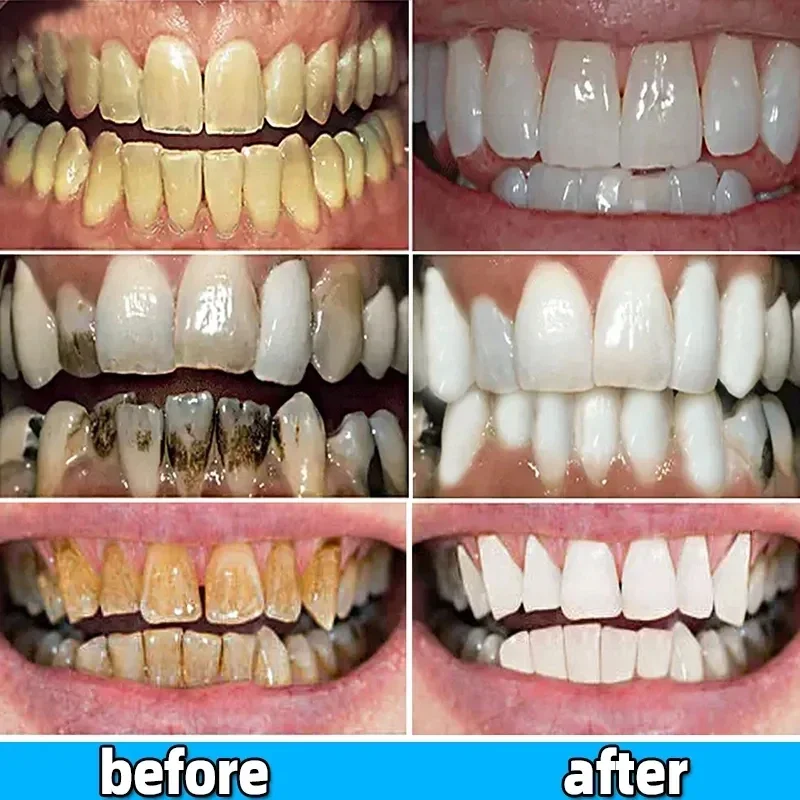 Dentes branqueamento creme dental, Dental Calculus mancha removedor, Mau hálito remover, Clareamento, Prevenção da periodontite, Dental Cleansing Care