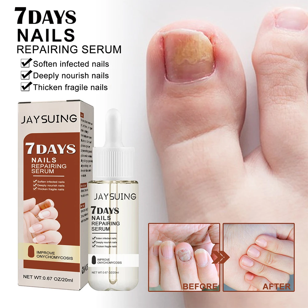 Nail Fungus Treatment Serum Toe Fungal Repair Products Hand Foot Care Removal Gel Anti Infection Onychomycosis Paronychia