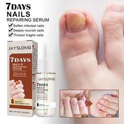 Nail Fungus Treatment Serum Toe Fungal Repair Products Hand Foot Care Removal Gel Anti Infection Onychomycosis Paronychia