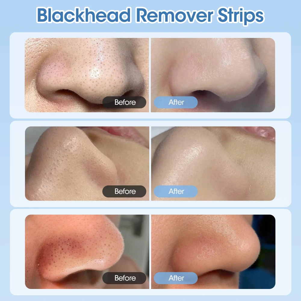 Mitesser Entferner Set Vibration Gesicht Haut Wäscher & Mitesser Nase Patch Hautpflege Werkzeug Black Dots Extractor Gesicht Reiniger Set