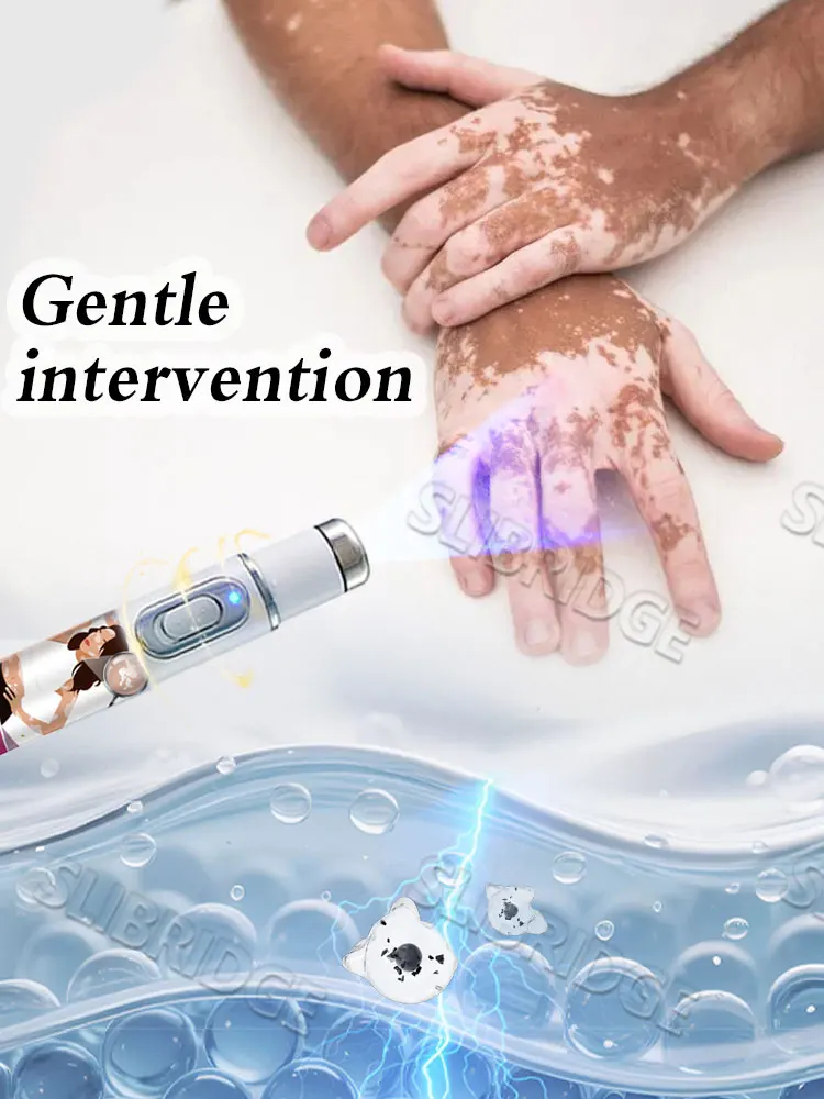 Caneta de luz azul remove rapidamente o vitiligo, uma ferramenta mais vendida para cuidados com a vitiligo.