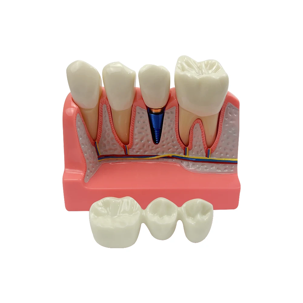 Dental Implant Teeth Model 4 Times Implant Analysis Crown Bridge Removable Model Dentistry Demonstration Tools Dentist Teaching