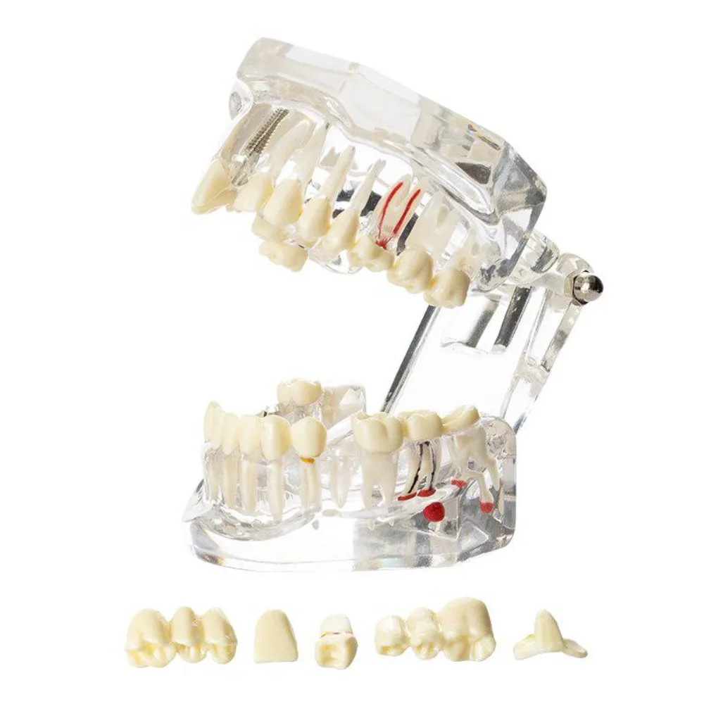 Dental Implant Bridge Model, Transparent And Detachable Dental Restoration Simulation, Used For Dental Training To Assist Learni