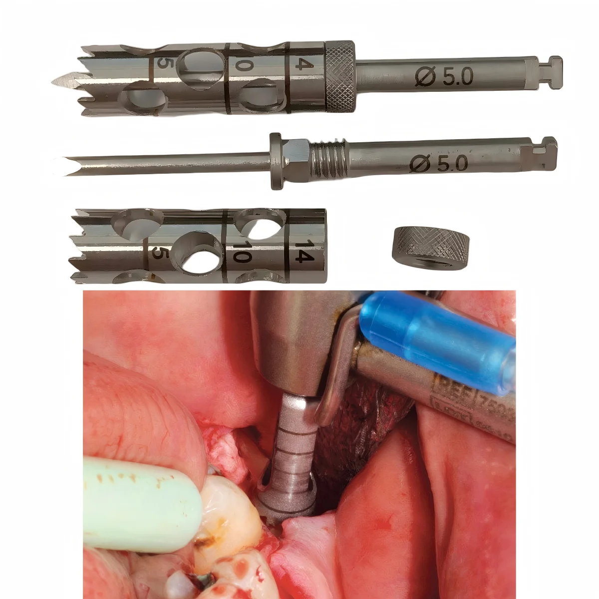Premium Dental Trephine Drill Bit Set Stainless Steel Bone Core Harvesting Bur for Implant Surgery and Autogenous Bone Grafting