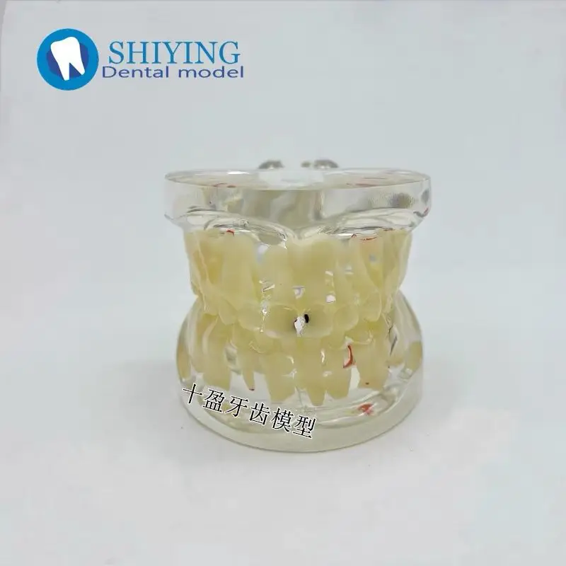 Dental Oral Teaching Model Caries Development Demonstration Crystal Adult Pathological Model Dental Anatomy Display
