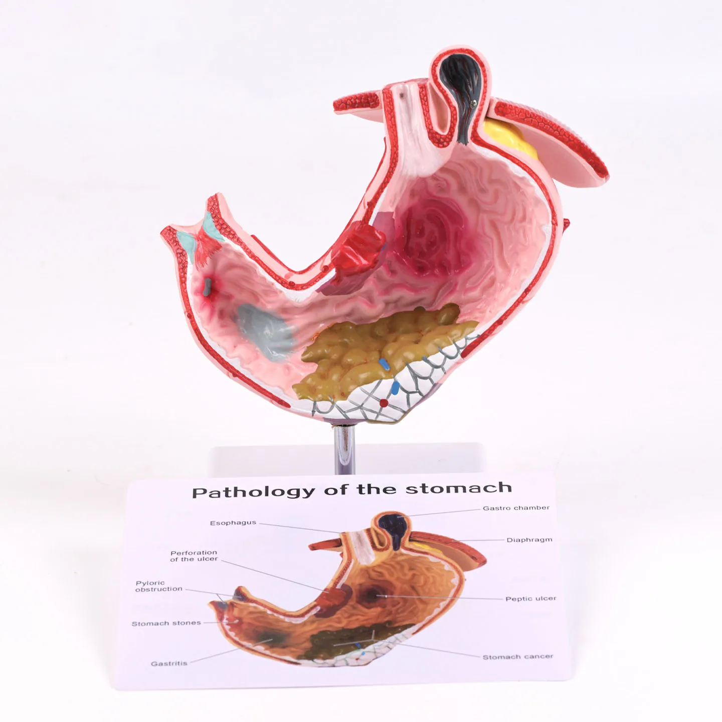 Pathological Stomach Model Human Digestive System Anatomy Coronal Section Anatomy Pathological Stomach Model