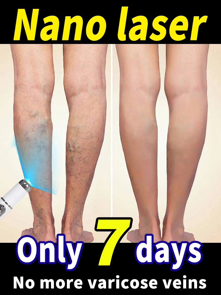

Hot selling varicose vein laser treatment products in 2025