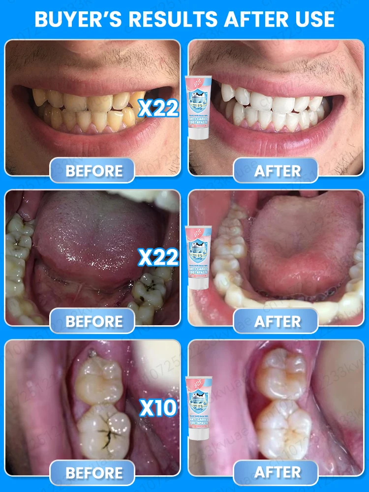 Pasta de dientes anticaries remineralización dental recuperación esmalte reparación fortalecimiento restauración caries protección dental dientes