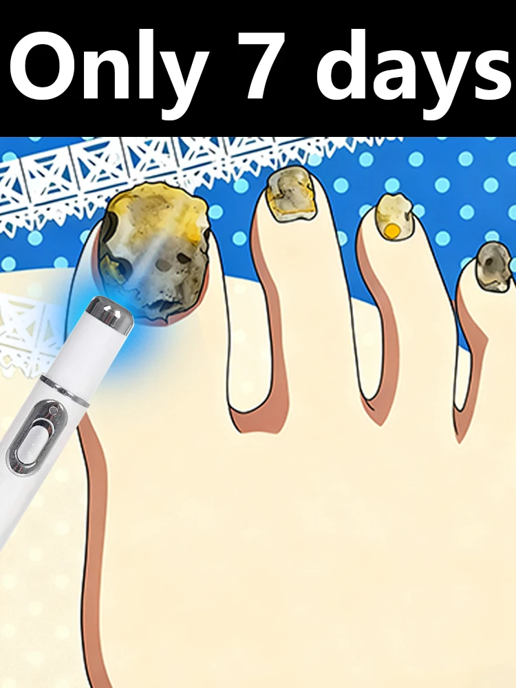 

2025 new upgraded blue light pen to easily solve various nail fungus problems at home