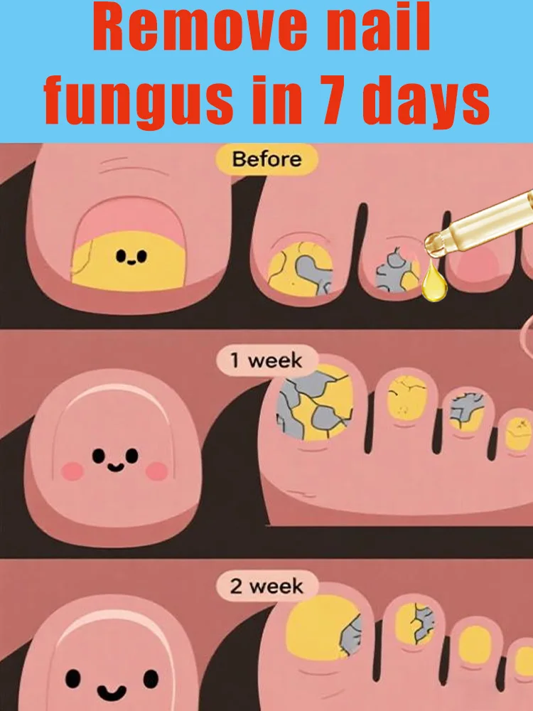 

Say Goodbye To Onychomycosis, No Recurrence, No Damage To Nails.