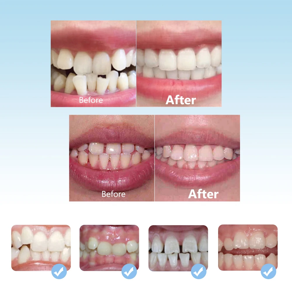 Zahn ärztliche kiefer ortho pä dische Zahnspangen Set Kind 3 Stufen Silikon Ausrichtung Trainer Zähne Halter Bruxismus Mundschutz Kinder Zähne Glätte isen – Detail 6