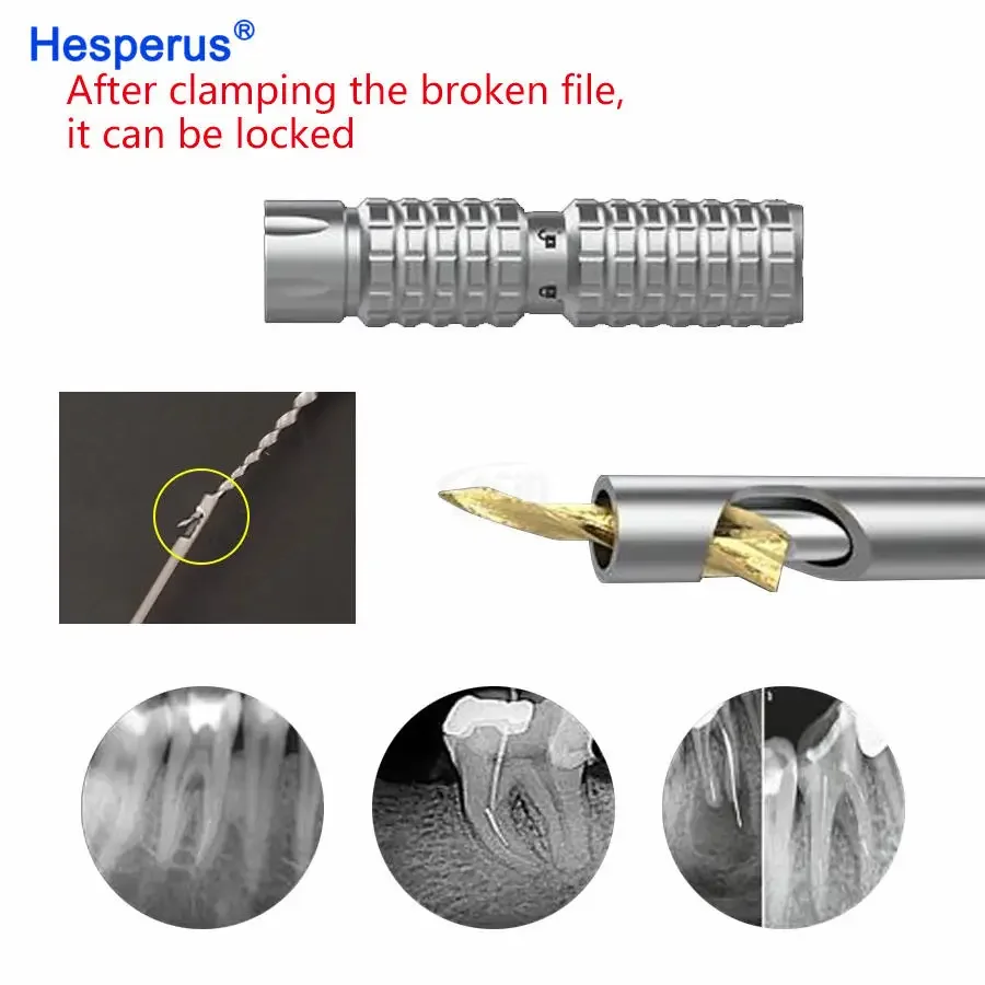 Extracteur de fichiers endodontiques pour traitement de canal radiculaire, équipement dentaire, kit de suppression de fichiers cassés