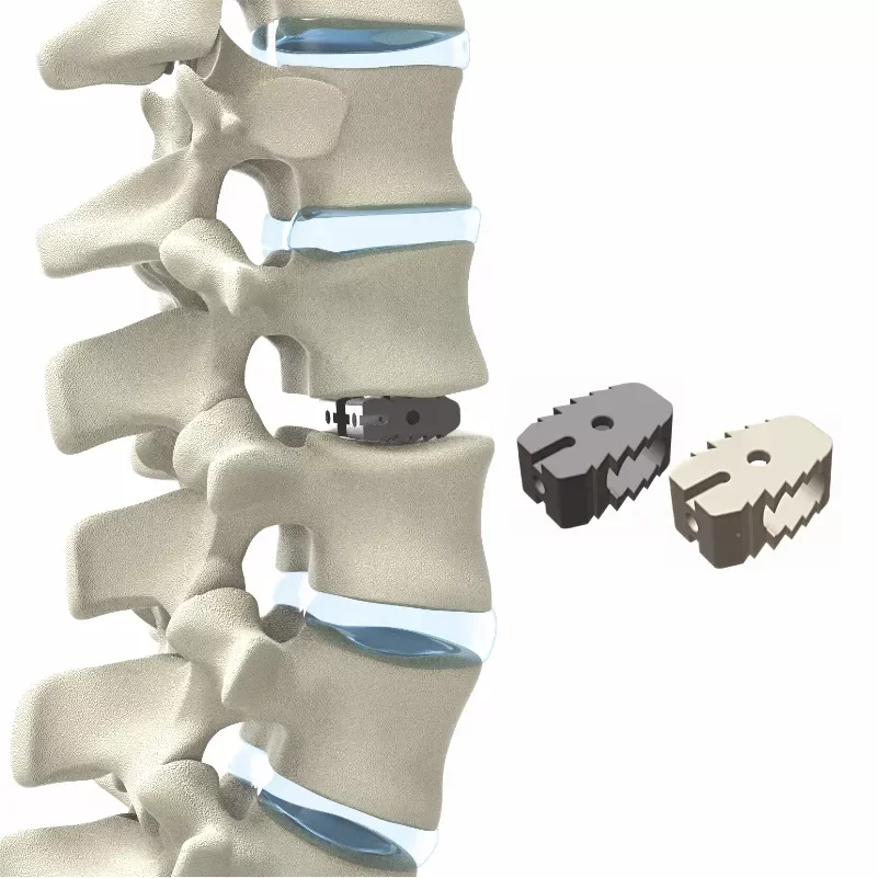 Spine Implants Lumbar Fusion Cages Cervical Cage Spinal Cage for Orthopedic Implants Bone Implants