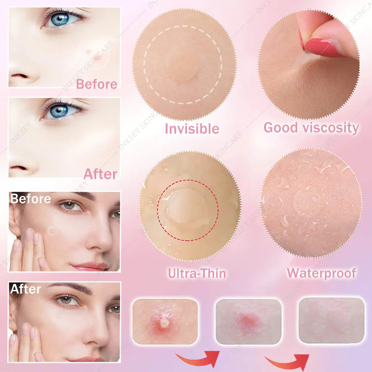 72-360Pcs 0.1mm Acne Pimple Patch Stickers Invisible Blemish Spot Cover Waterproof Acne Treatment Pimple Remover Tool Skin Care